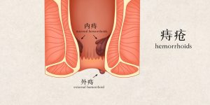 偶尔喝白酒的人会得痔疮吗？得痔疮能喝酒吗？